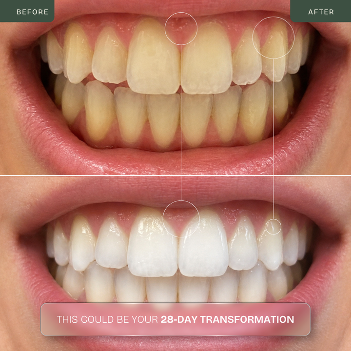Pro Dual-Light Teeth Whitening Kit — Blue + Red LED