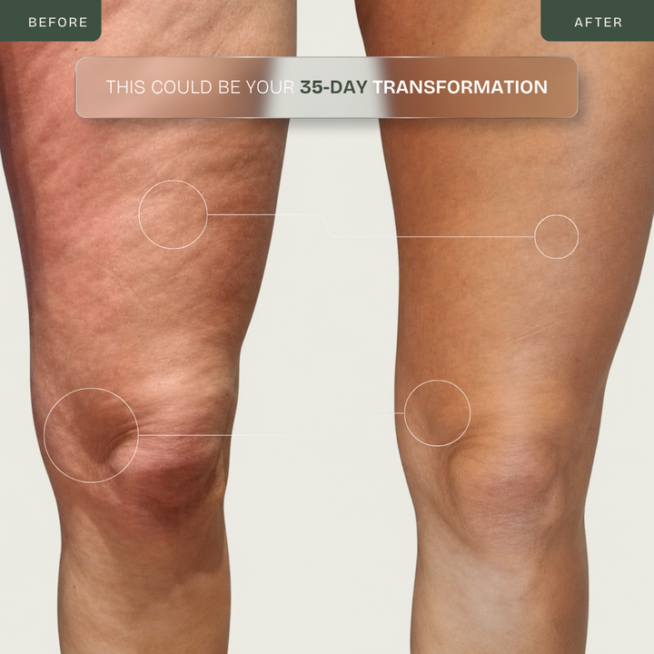 4-in-1 RF Body Sculptor — Cellulite, Firming & Toning